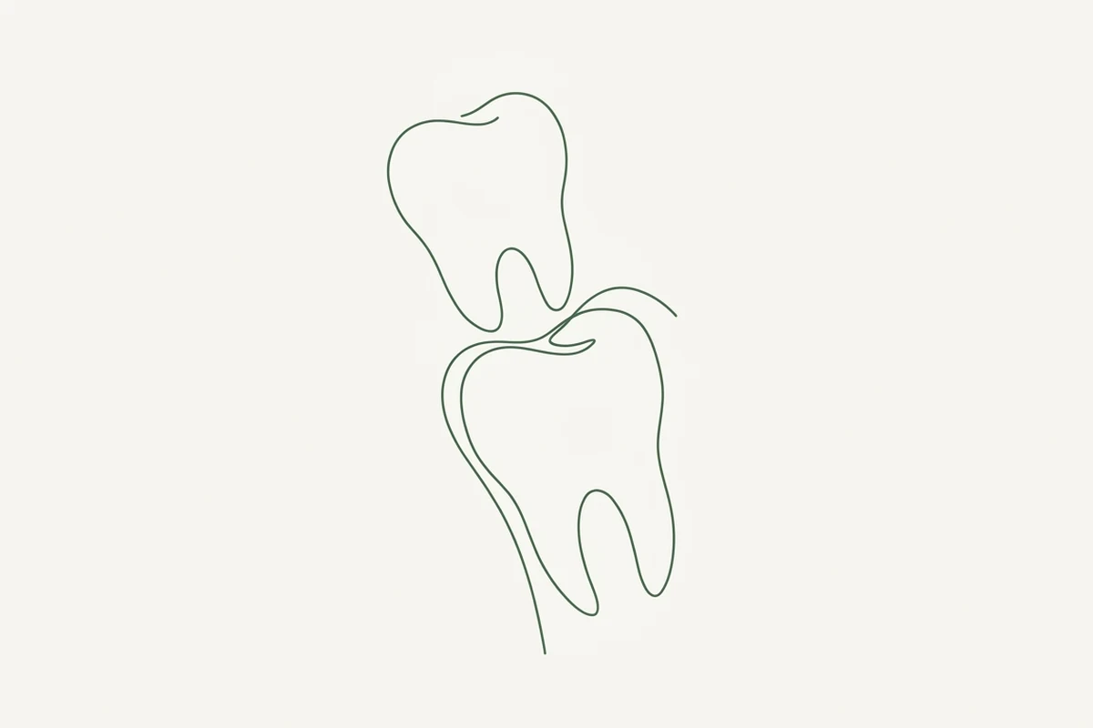 Il dente da latte sopra e il permanente che spinge da sotto